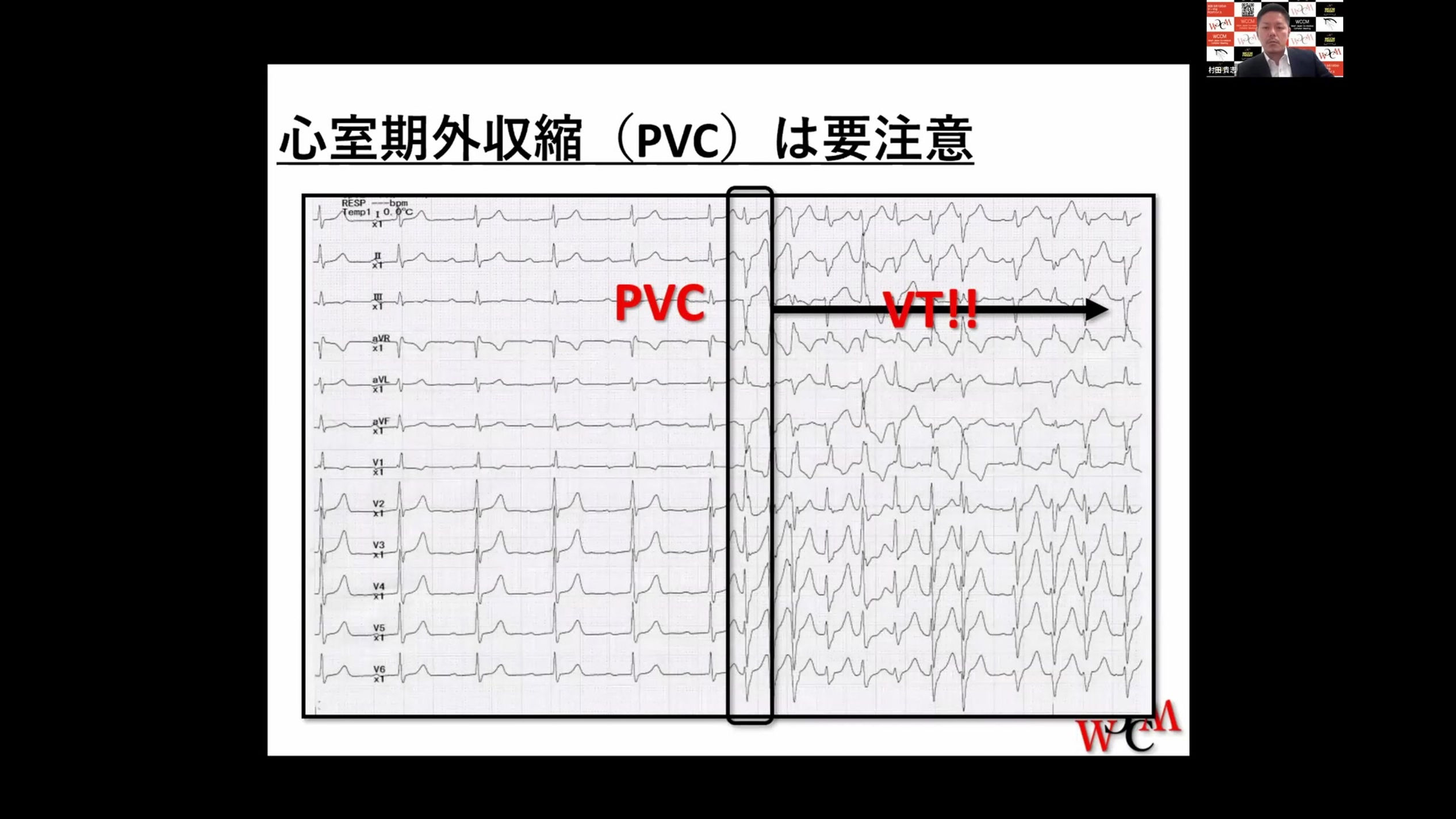 WCCM FRIDAY2023 5/7 CAG・モニタリング・合併症